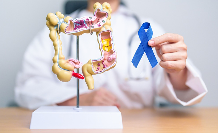 Kalın Bağırsak Kanseri (Kolorektal Kanser)