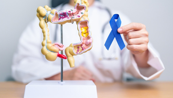 Kalın Bağırsak Kanseri (Kolorektal Kanser)