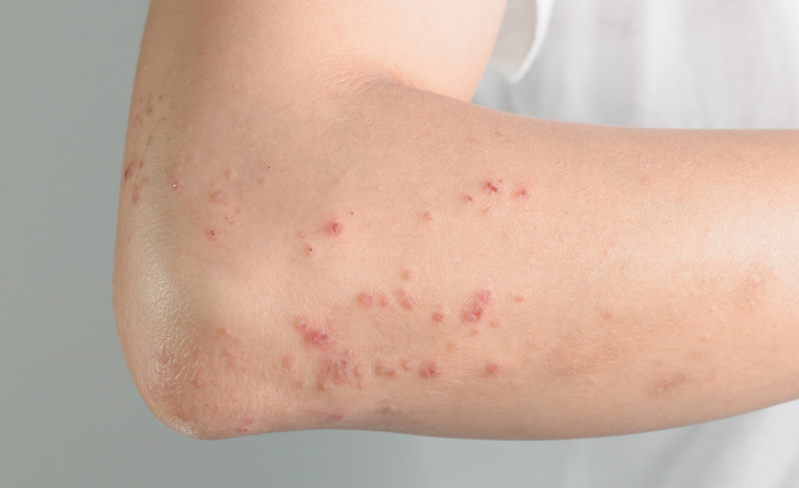 Behçet Hastalığı