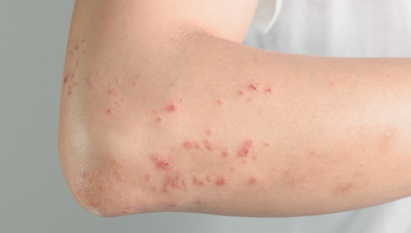 Behçet Hastalığı