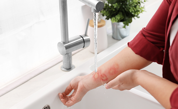 Yanıkta İlk Yardım